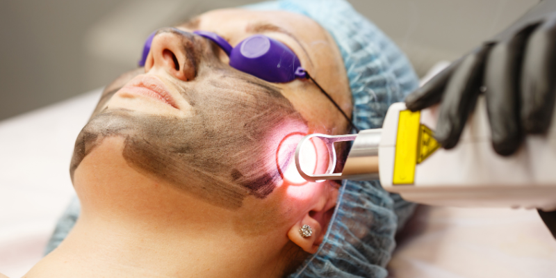 Benefits of Carbon Laser Facial Treatment You Need to Know