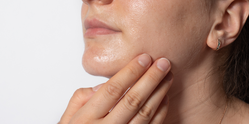 How Can I Prevent Oily Skin: Simple Tips for a Fresh Look