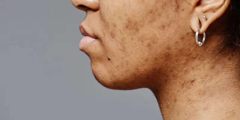 Understanding Dark Spots on Face