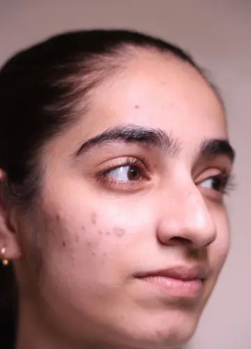 glp 1 acne Effective GLP-1 Weight Loss A Closer Look at the